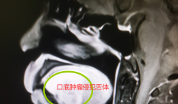 【欽二醫(yī)技術(shù)】口底癌侵犯舌體并頸淋巴結(jié)轉(zhuǎn)移，專家妙手成功再造舌體