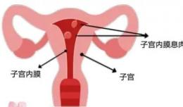 【欽二醫(yī)生說(shuō)】小小子宮內(nèi)膜息肉 除了引起出血還可導(dǎo)致“不孕”
